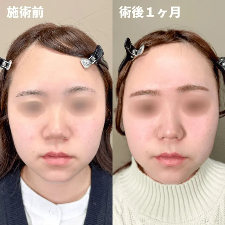 鼻尖形成の症例① 女性