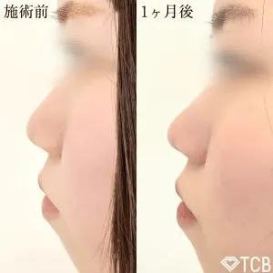 鼻尖形成の症例③ 20代女性