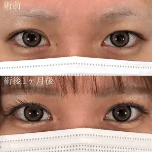 TCBの二重整形の症例