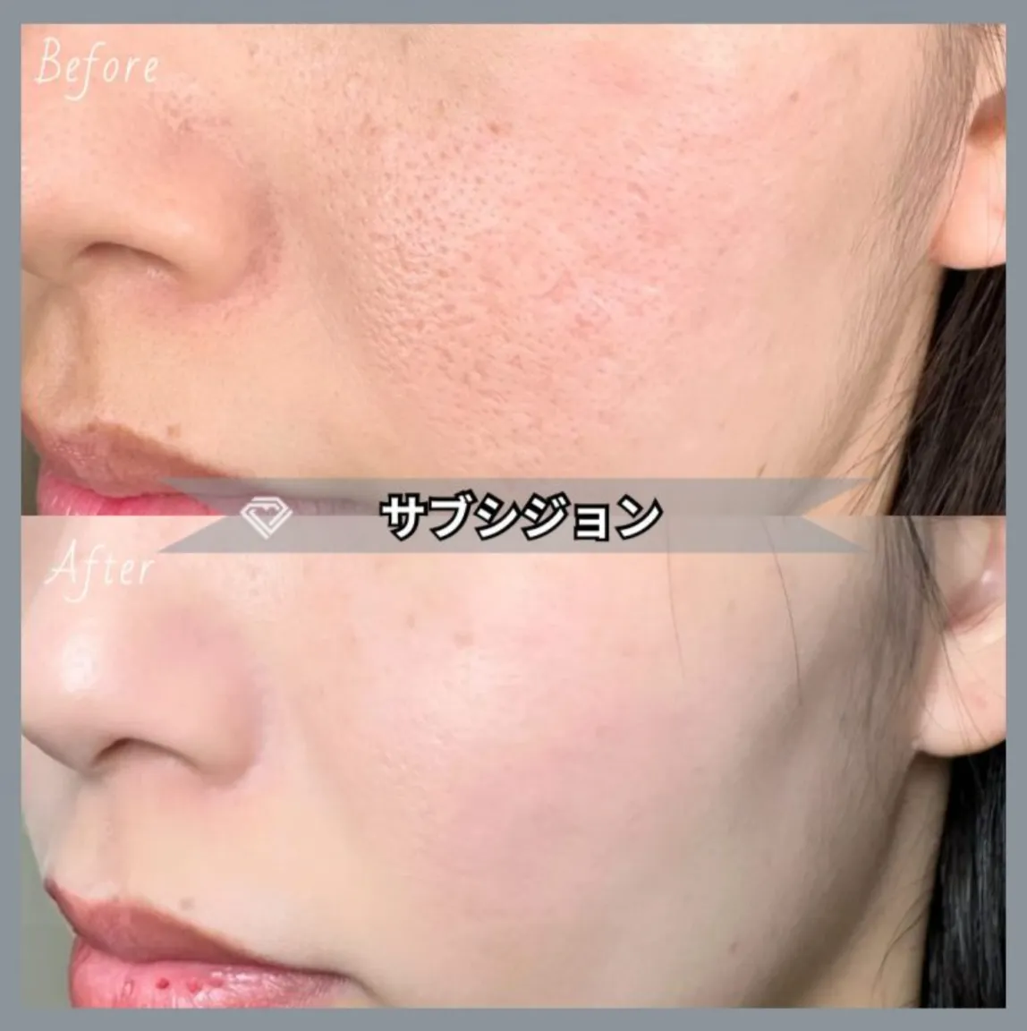 TCBのサブシジョン ビフォーアフターの症例写真