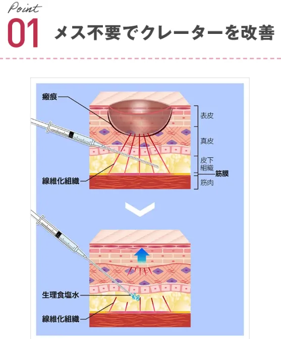 TCBのサブシジョンはメス不要でクレーターを改善