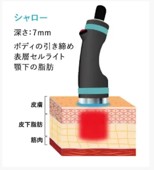 湘南美容クリニックでオンダリフトで使用するハンドピースのシャロー