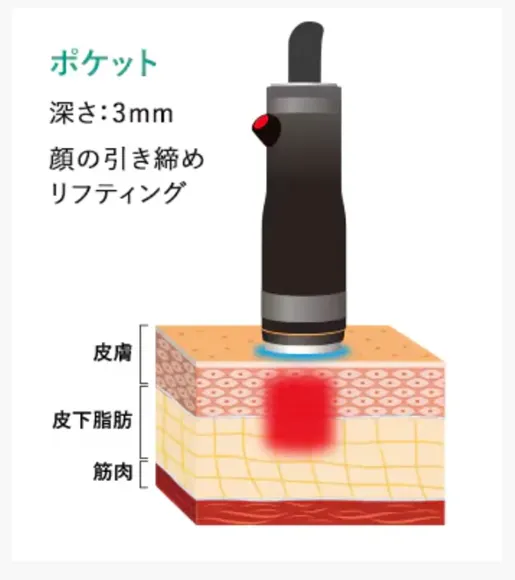 湘南美容クリニックでオンダリフトで使用するハンドピースのポケット