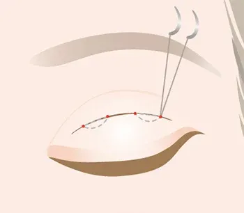 大分で二重整形が受けられるクリニックの埋没法