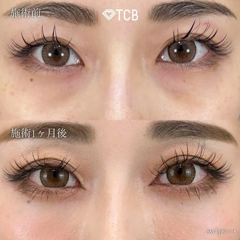 TCBの二重埋没の症例