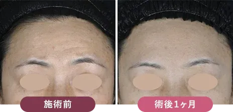 梅田でリジュラン注射が安いおすすめクリニックの湘南美容クリニック症例写真②