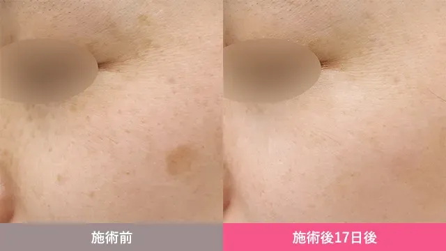 湘南美容クリニック　ピコスポットの症例写真