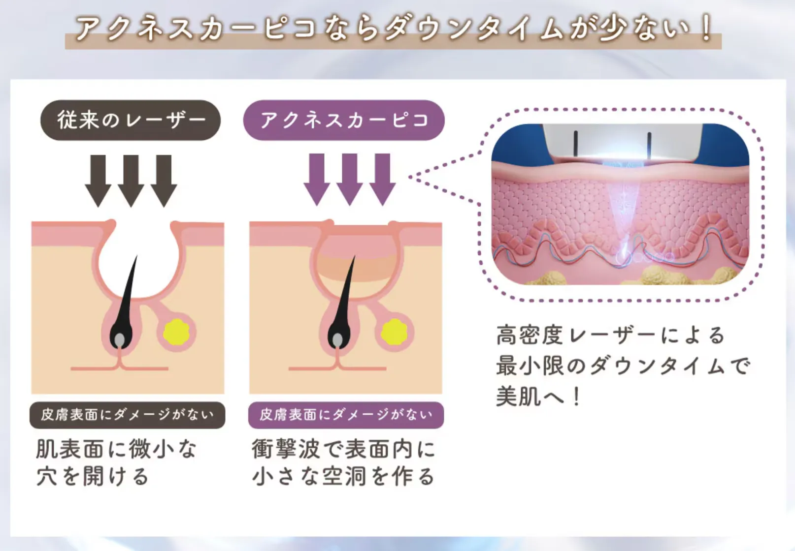 湘南美容クリニックのアクネスカーピコはダウンタイムを最小限に抑えられる