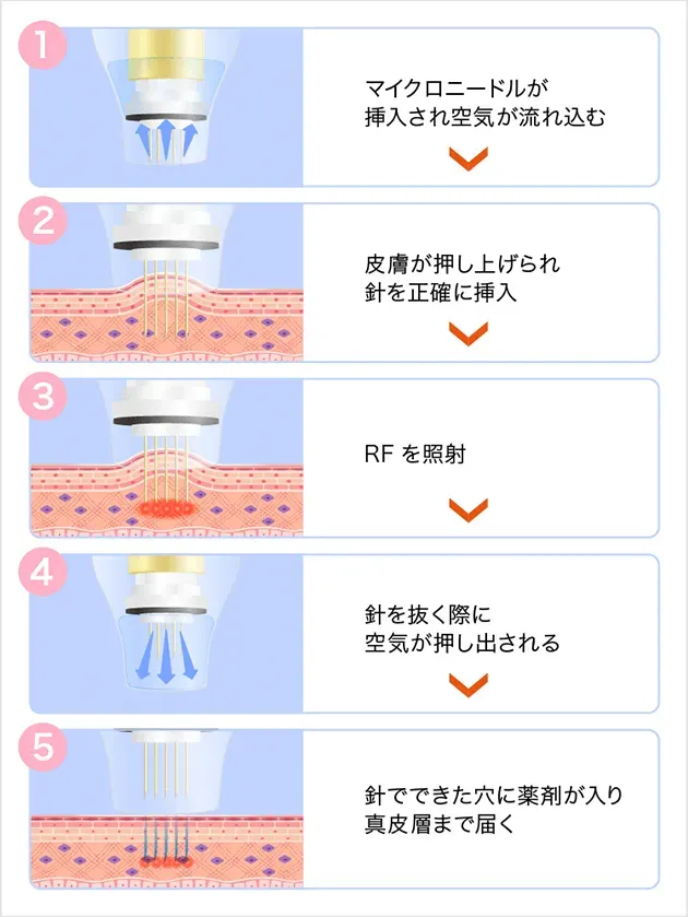 TCBのドラッグデリバリーシステムの説明