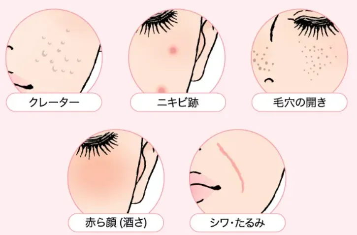 TCBポテンツァ対応可能な肌悩み