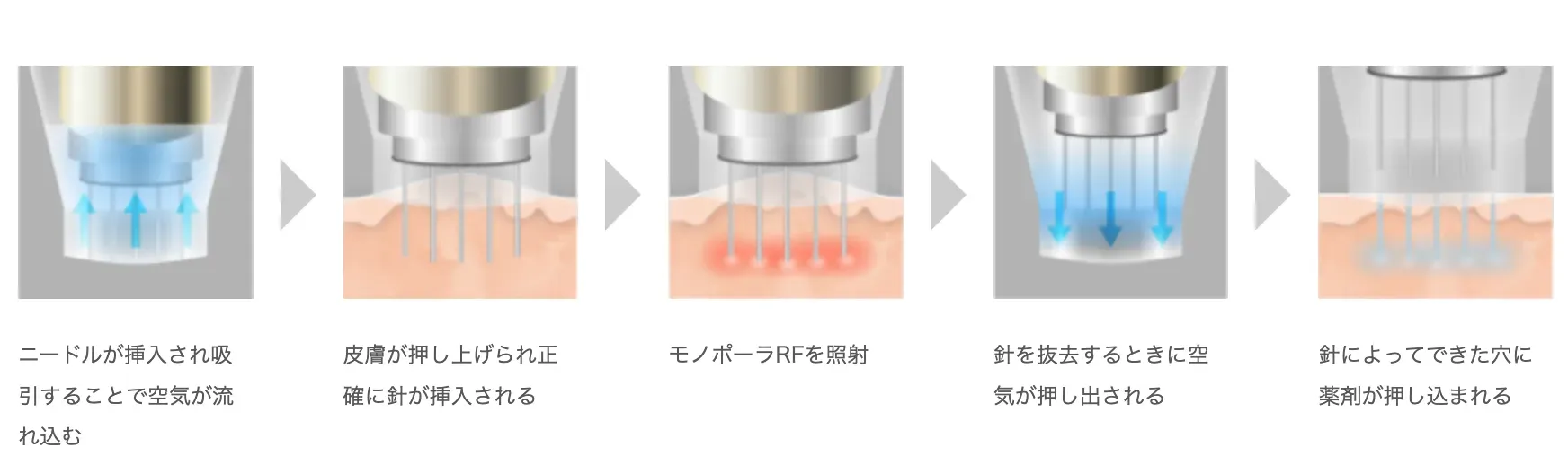 ルラ美容クリニックのポテンツァ解説