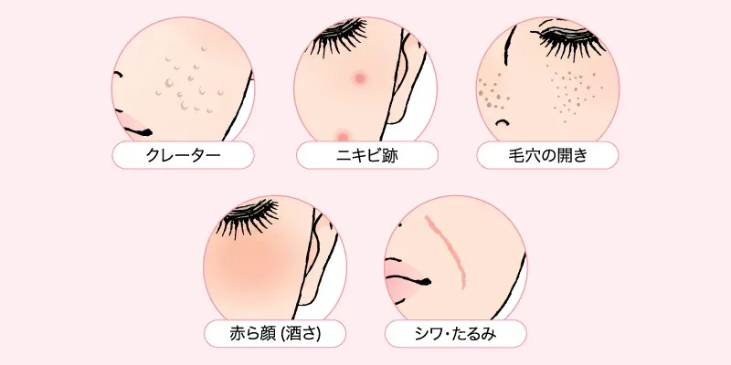名古屋でポテンツァが安いおすすめのクリニック トラブル一覧