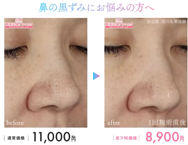湘南美容クリニックのブラックピールの症例写真と料金