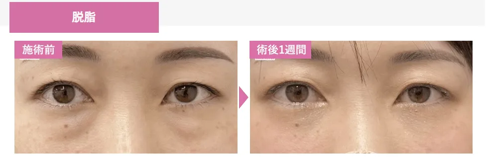 SBC湘南美容クリニックの6月の月替わりキャンペーン クマ取りの症例写真①