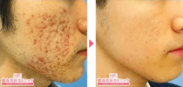 神戸でケミカルピーリングが安いおすすめのクリニック　湘南美容クリニックの症例写真