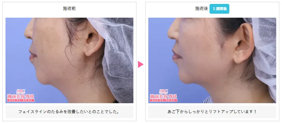 湘南美容クリニックの医療ハイフが上手い先生は？　症例写真⑧