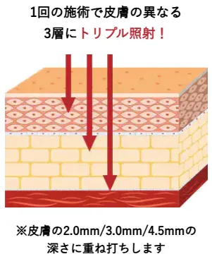 湘南美容クリニックの医療ハイフが上手い先生は？　トリプル照射