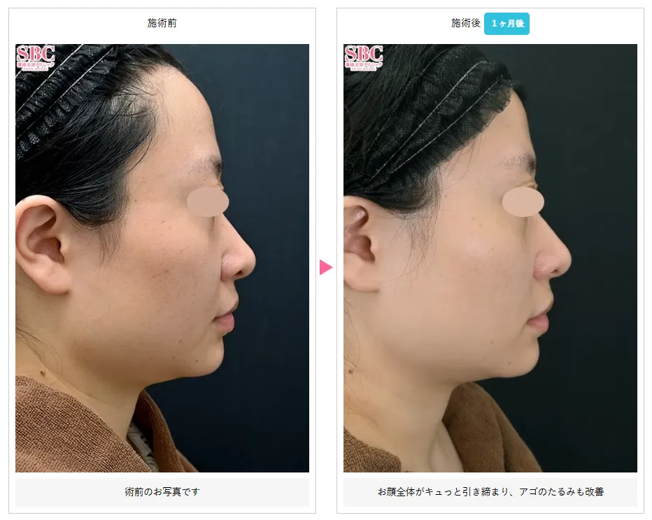 湘南美容クリニックの医療ハイフが上手い先生は？　症例写真⑤