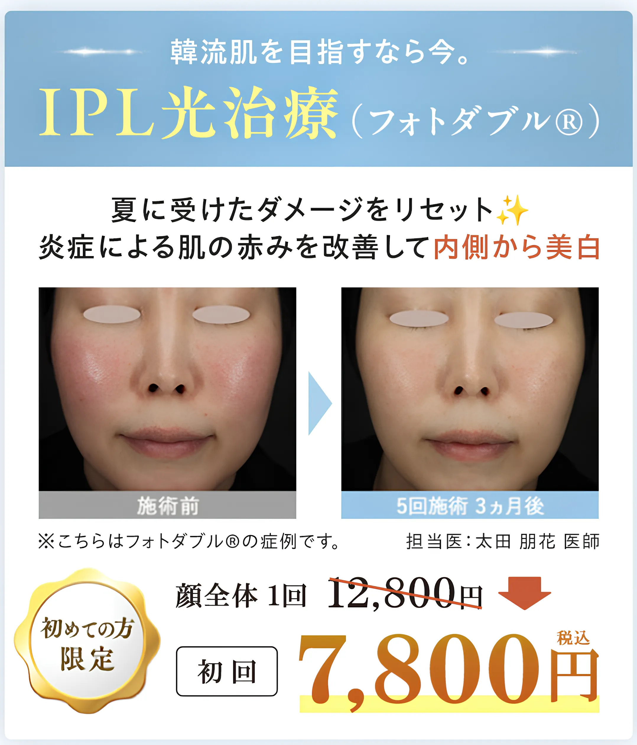 湘南美容クリニックのIPLは初回限定キャンペーンで7,800円