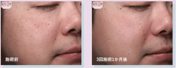 湘南美容クリニックのIPLの症例写真
