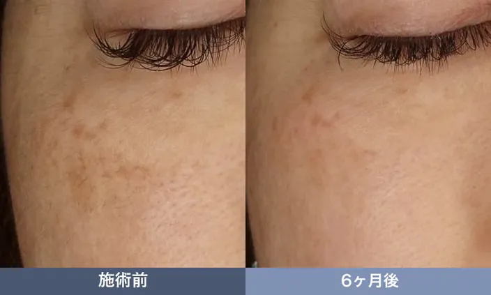 湘南美容クリニックのレーザートーニングの口コミ・ブログの評判　症例写真②