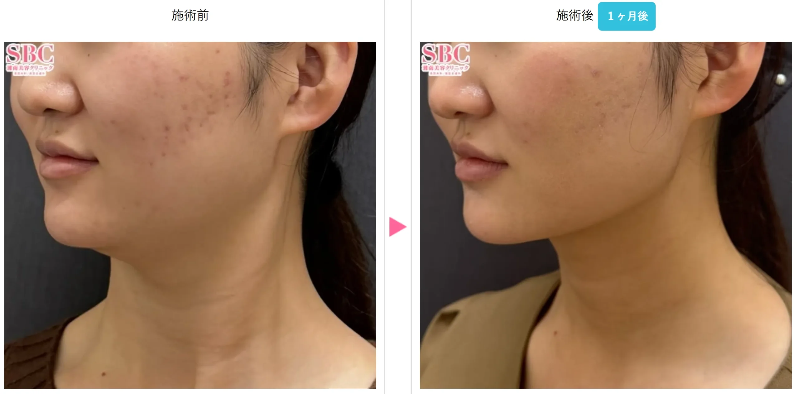 SBC湘南美容クリニックの5月の月替わりキャンペーン オンダリフトの症例写真①