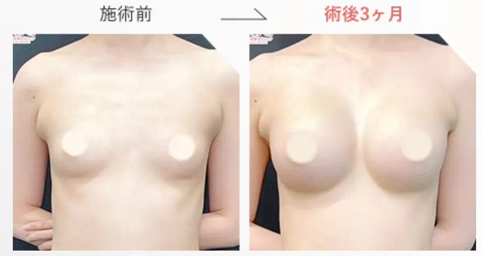SBC湘南美容クリニックの7月の月替わりキャンペーン ハイブリッド豊胸の症例写真