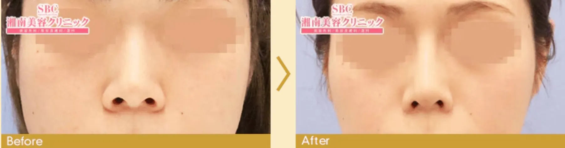 SBC湘南美容クリニックの7月の月替わりキャンペーン スタンダードプラン鼻フル忘れ鼻セットの症例写真