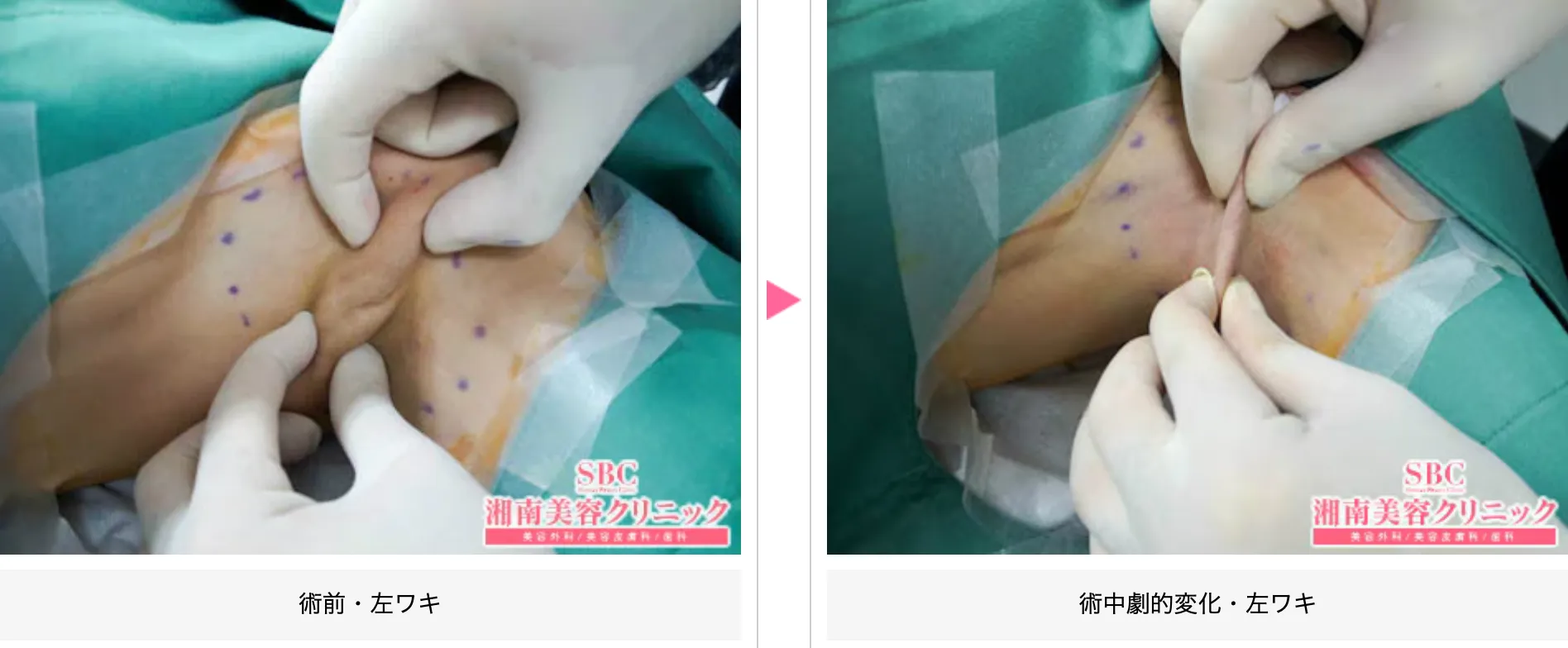湘南美容クリニックの脇ボトックスの症例