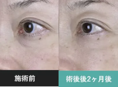湘南美容クリニックのモフィウス8の症例