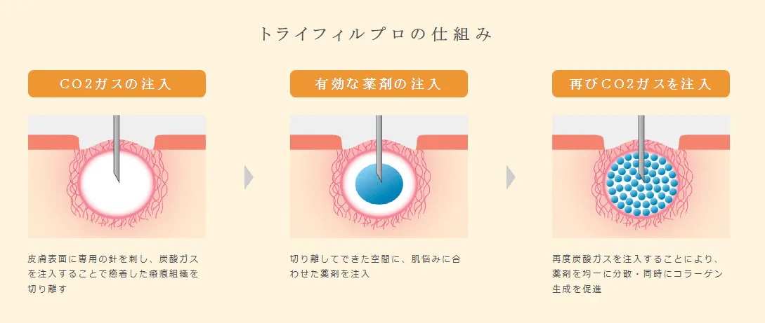 渋谷でトライフィルプロが安いおすすめクリニック トライフィルプロの仕組みの画像