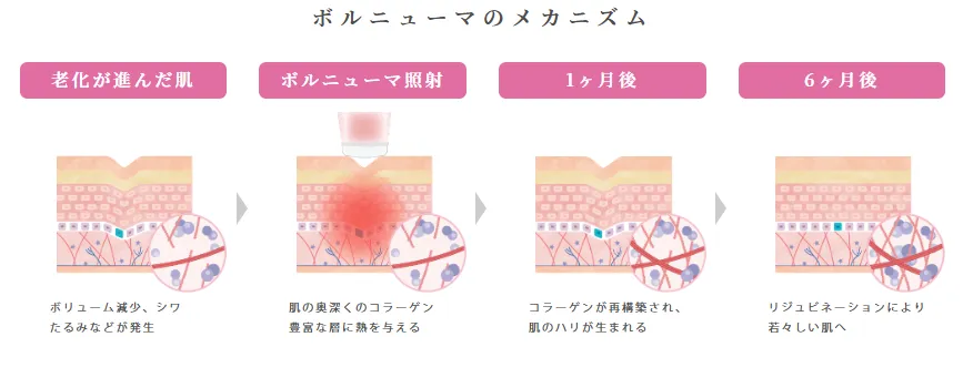 ボルニューマのメカニズム