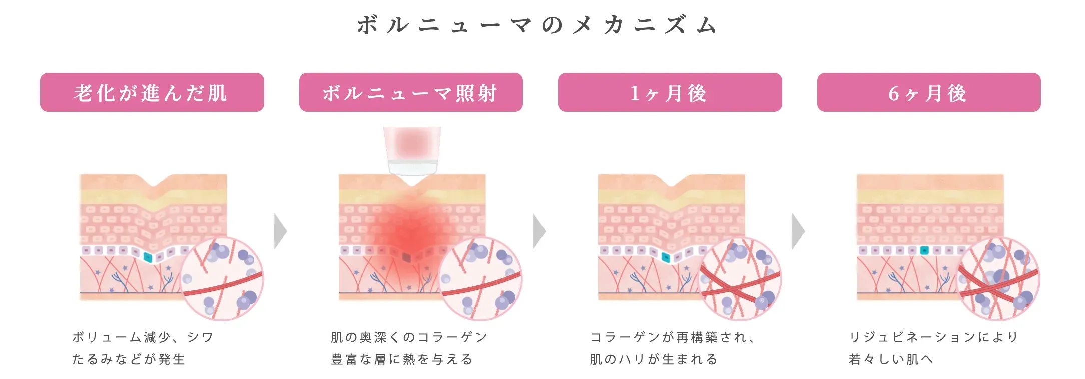 ボリニューマのメカニズム