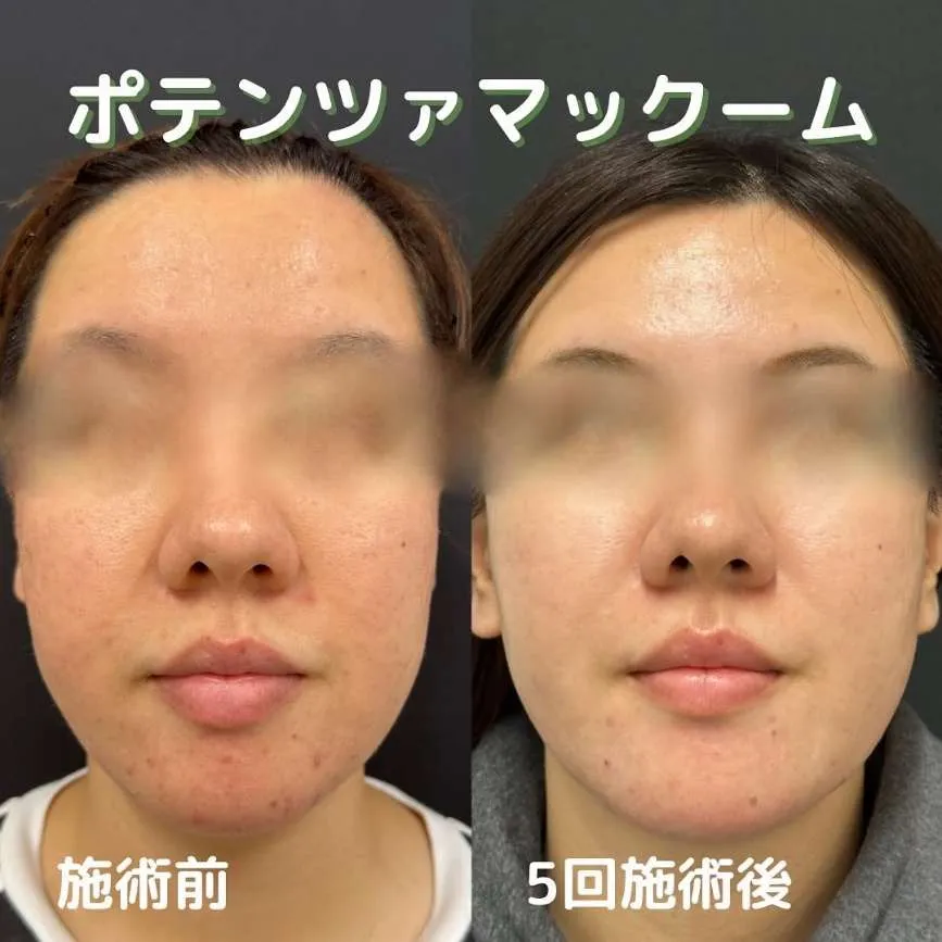 ルラ美容クリニック静岡院ポテンツァ症例写真