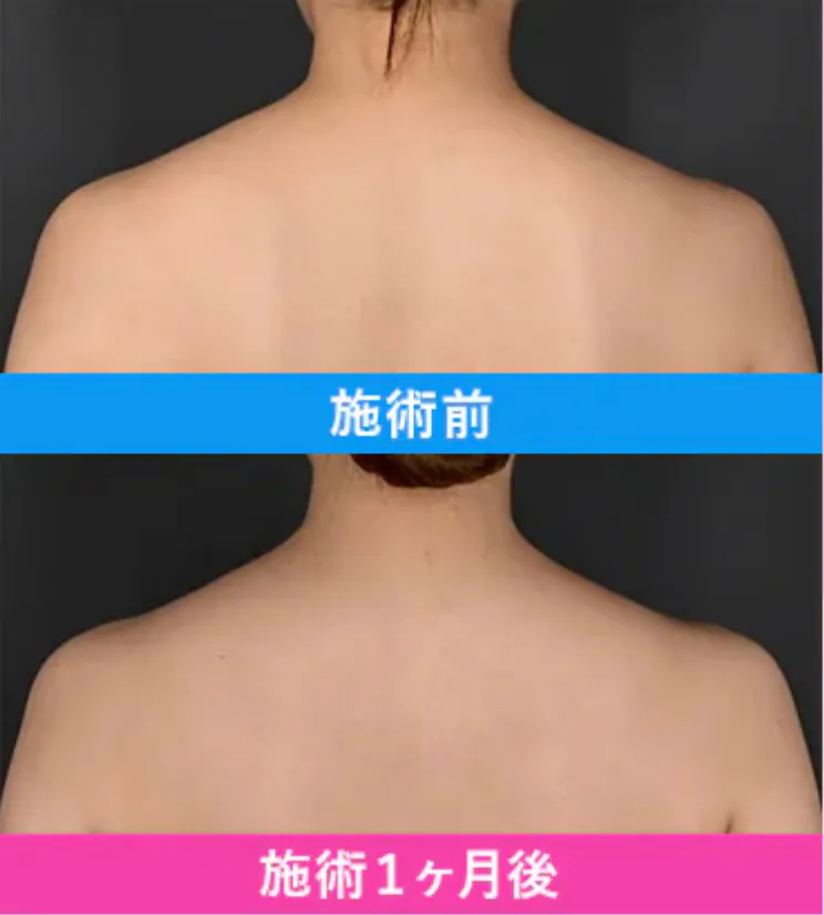 湘南美容クリニック(旧:湘南美容外科)の肩ボトックスの症例写真
