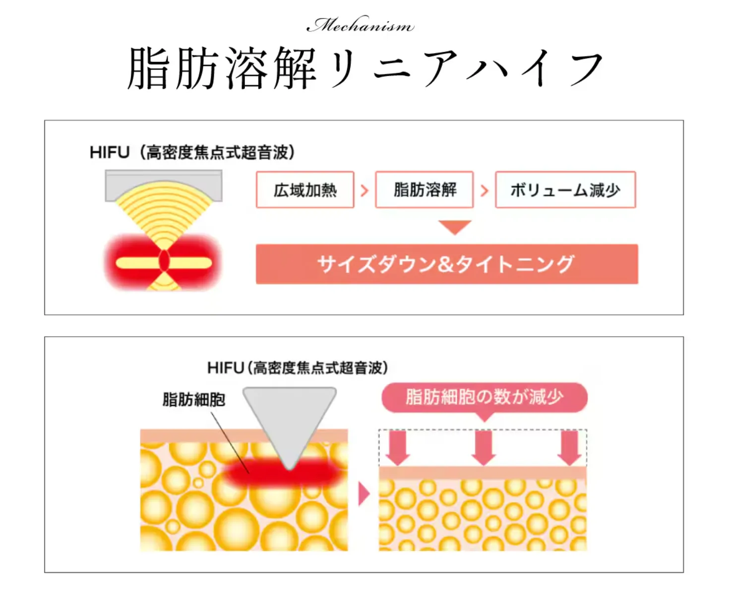 湘南美容クリニック(旧:湘南美容外科)の脂肪溶解リニアハイフの施術内容