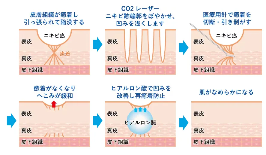 サブシジョンのしくみ