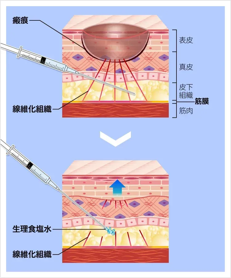 TCB東京中央美容外科　サブシジョンの施術方法