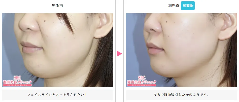 湘南美容クリニックのハイフの症例写真
