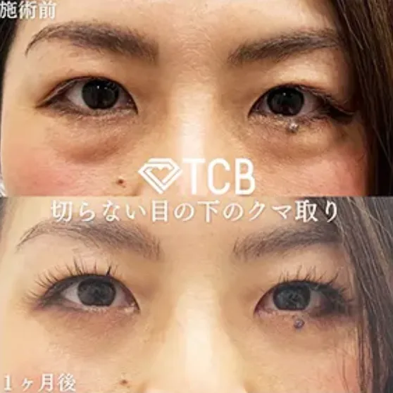 TCBのクマ取り再生注射の症例