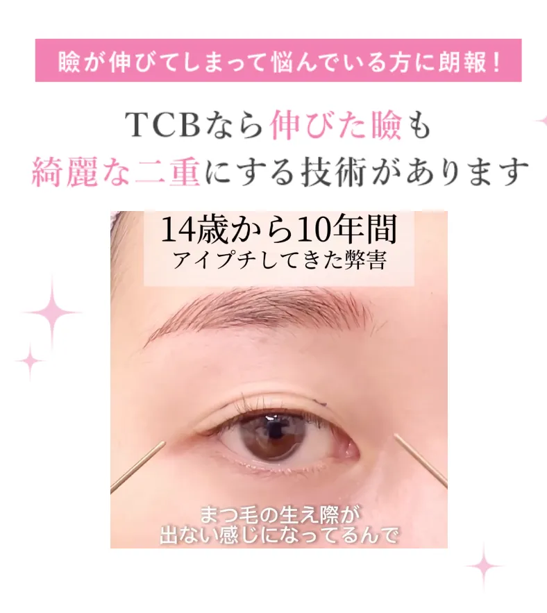 立川で二重整形がおすすめのクリニック TCBの症例写真