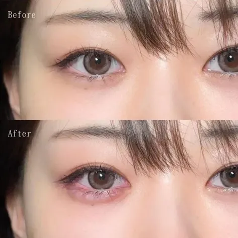 TCBのヒアルロン酸の症例写真