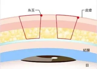 TCB二重術のダウンタイムは長い?ほぼゼロって本当?専門家が調査 術式③