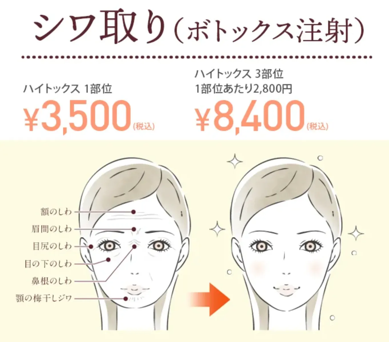 TCB しわ取り(ボトックス注射)
