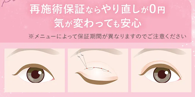 TCBの二重4,800円の口コミ評判!【いつまで受けられるのか調査】 TCBの再施術保証