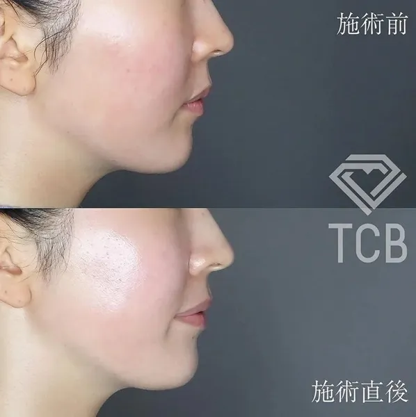 TCBの医療ハイフの口コミ評判 症例写真②