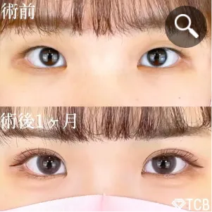 TCBの二重整形症例①