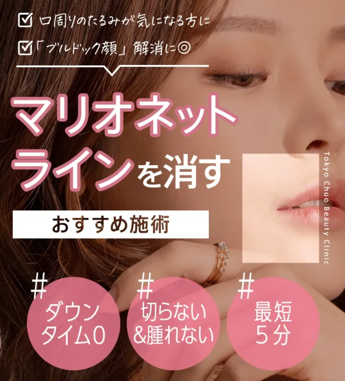 TCBのヒアルロン酸はマリオネットラインの解消を目指せる