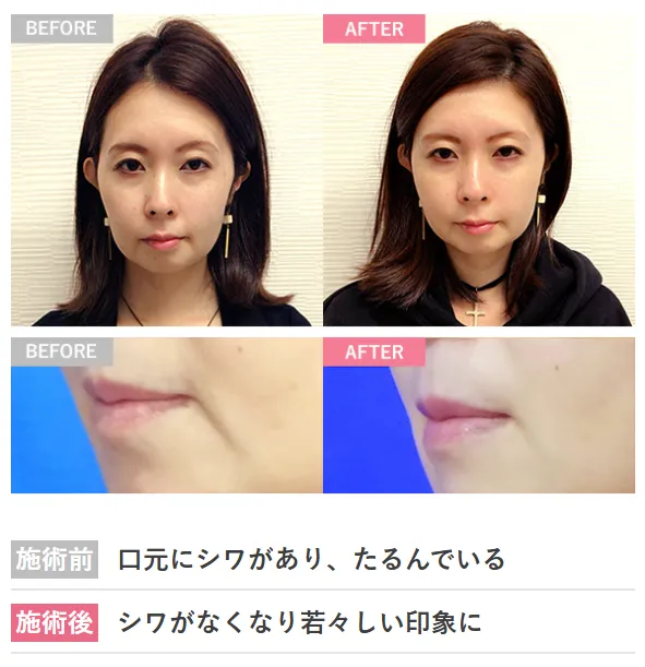 TCBのヒアルロン酸による施術で口元のしわ解消を目指せます