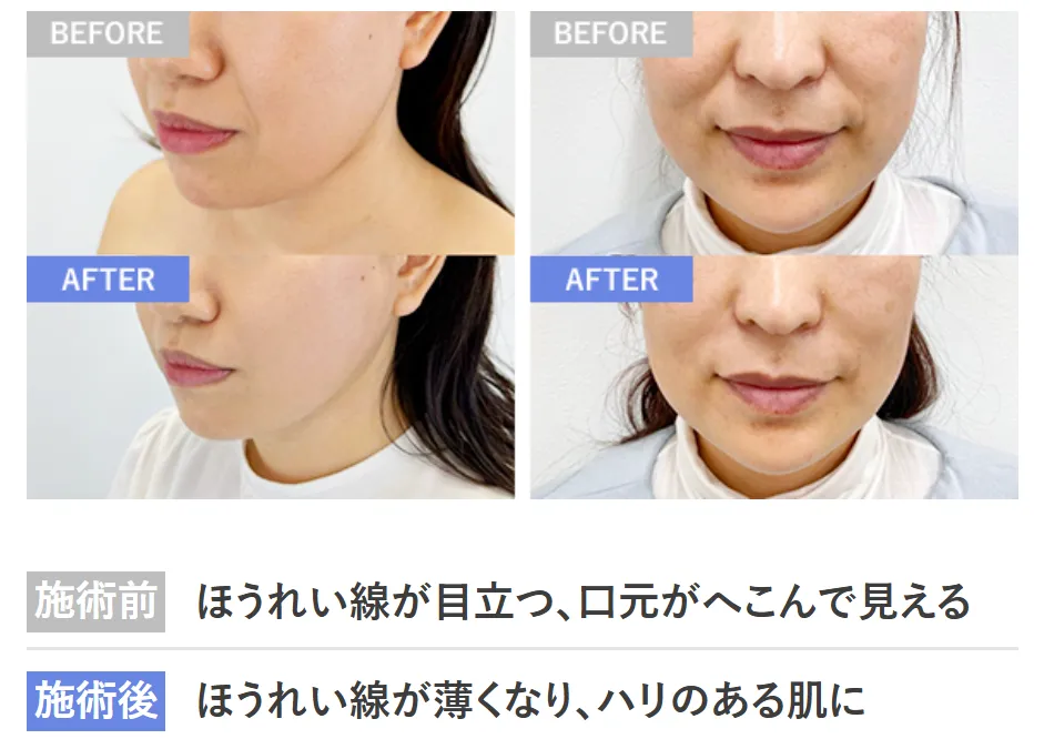 TCBのヒアルロン酸でほうれい線が薄くなり、ハリのある肌に変化